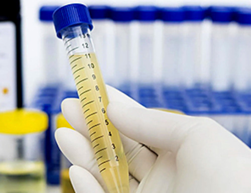 Prostate Cancer Breakthrough: Urine Test Avoids Unnecessary Biopsies