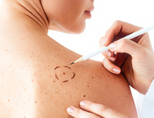 Nanoparticle-Based Combination Therapy for Resistant Melanoma