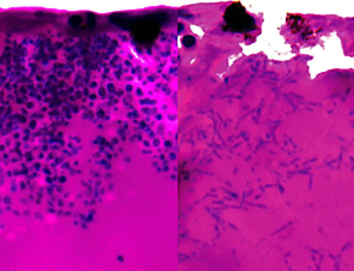 Deadly Hospital Fungus May Finally Have a Weakness