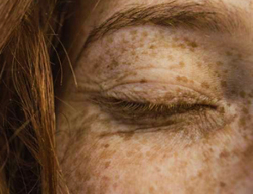 Lower doses of immunotherapy for skin cancer give better results, study suggests