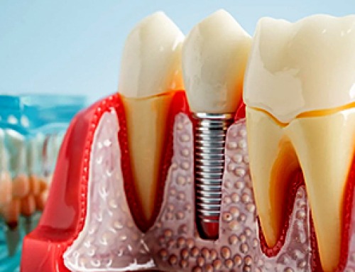 Researchers Solve the Mystery Behind a Billion-Dollar Dental Implant Disease