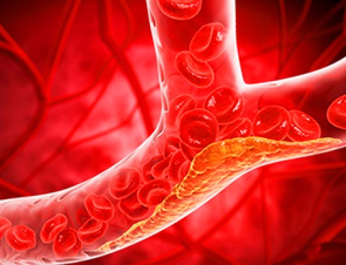 New Treatment Cuts “Bad” Cholesterol in Half for a Full Year